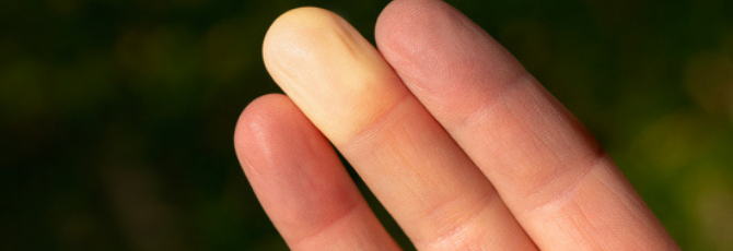 What is Raynaud's Disease? - Everything You Need to Know